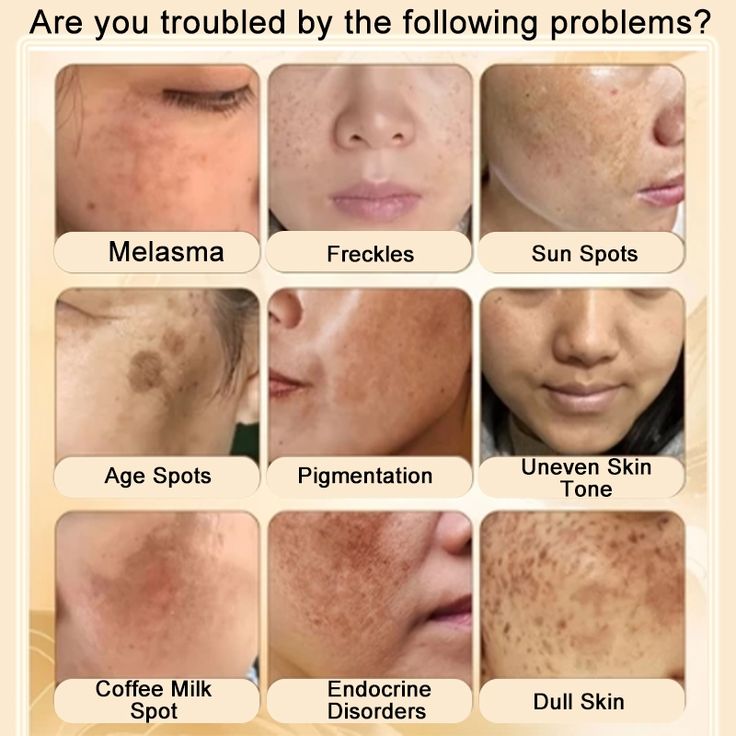 KOJIC ACID ANTI-PIGMENTATION CREAM (Bundle of 2)